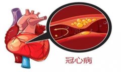 冠心病有什么急救要点 冠心病防范措施和预防